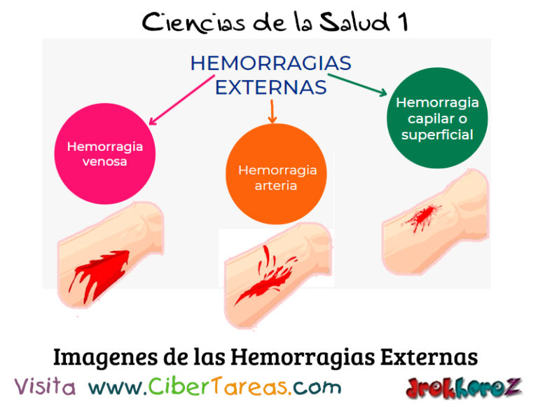 Clasificación y Tratamiento de las Hemorragias Externas Ciencias de