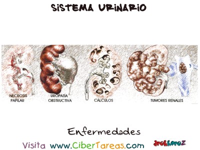 Enfermedades - Sistema Urinario